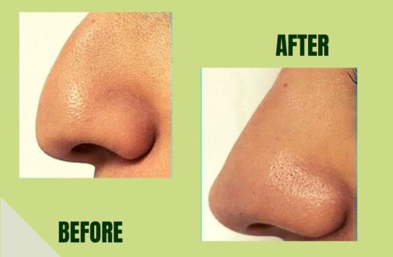 جراحة-تجميل-الأنف-في-مصر