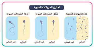 اسباب-العقم-عند-الرجال