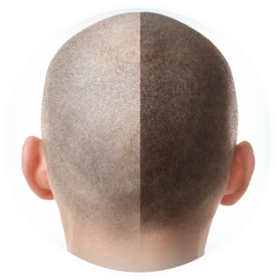 hair transplant