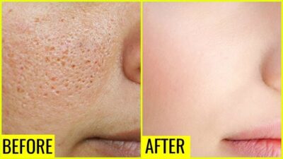 Facial pore reduction