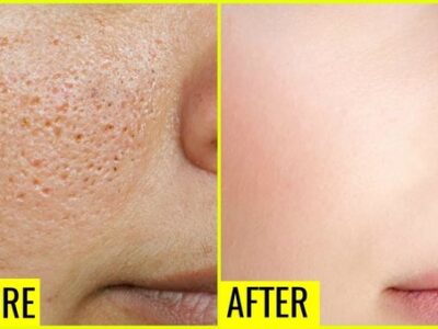 Facial pore reduction