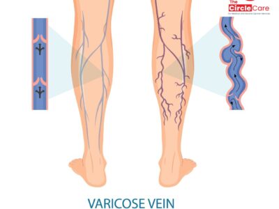 الدوالي-varicose-veins-the-circle-care-destination-to-best-doctors