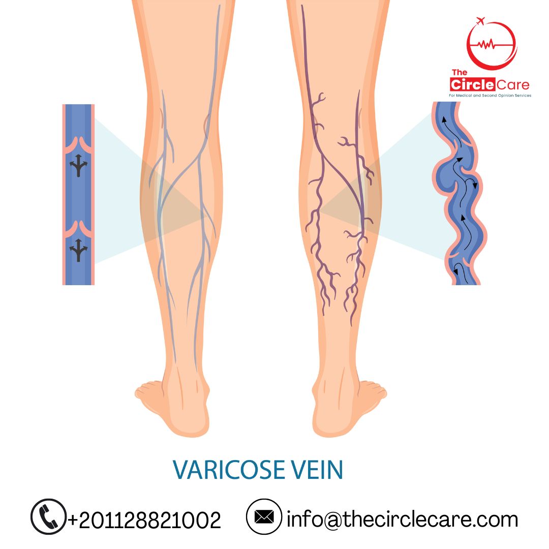 الدوالي-varicose-veins-the-circle-care-destination-to-best-doctors