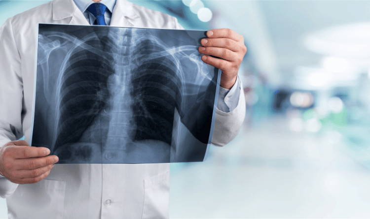 Lung Cancer