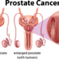 advanced_prostate_cancer_malignant_tumer-05-23_the_circle_care_destination_to_best_doctors