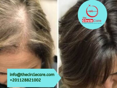 The FUE technique is the most expensive type of hair transplant in Egypt at a cost of , 1500 US dollars.
