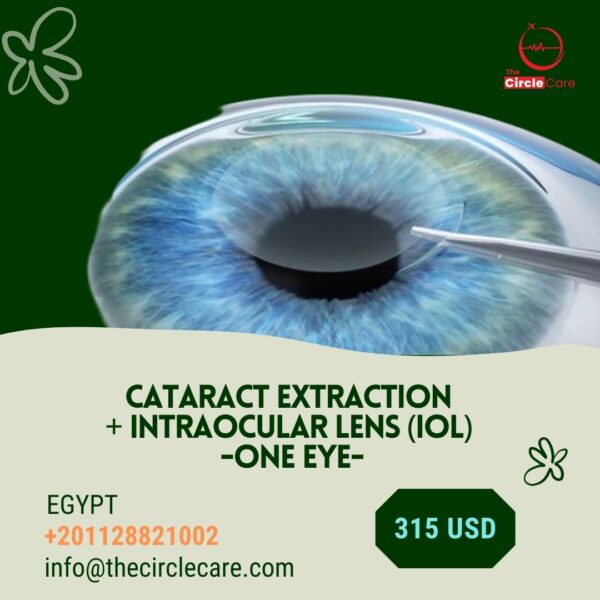 Cataract Extraction + Intraocular lens (IOL) (One Eye) ازالة مياه بيضاء + زرع عدسه