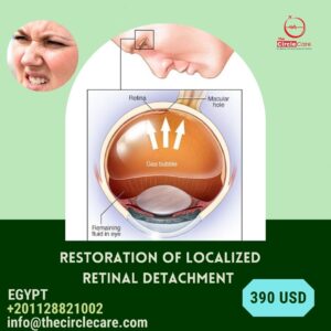 Localized Retinal Detachment انفصال شبكي the cheapest in Egypt